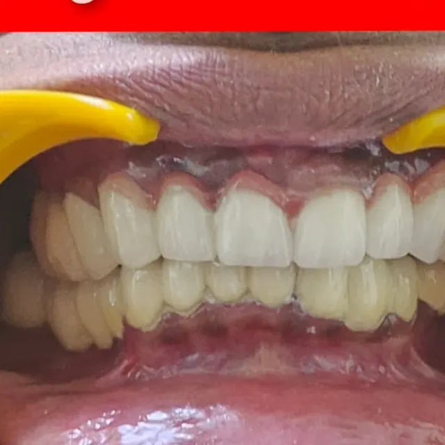 After view of a patient smile transformation