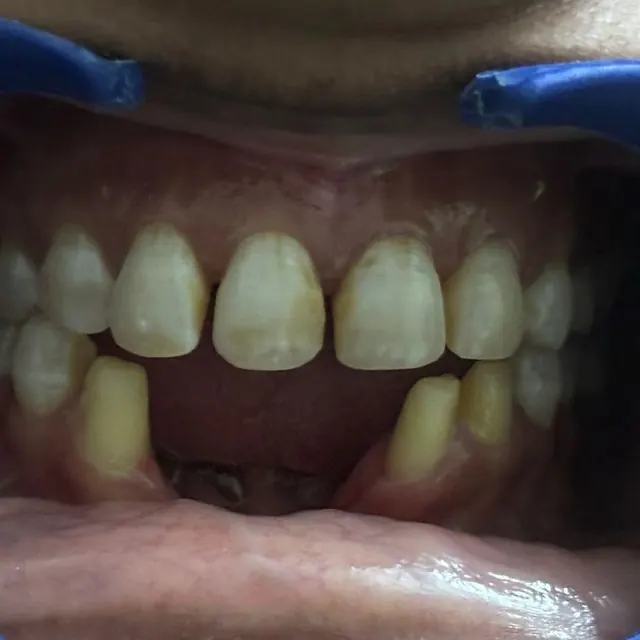 Before view of a patient smile transformation