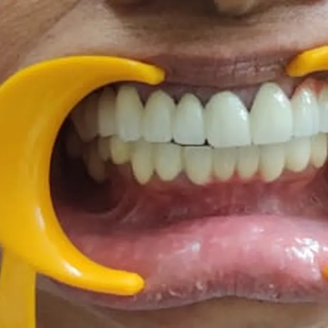 After view of a patient smile transformation