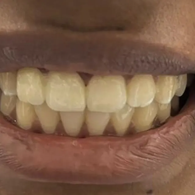 After view of a patient smile transformation