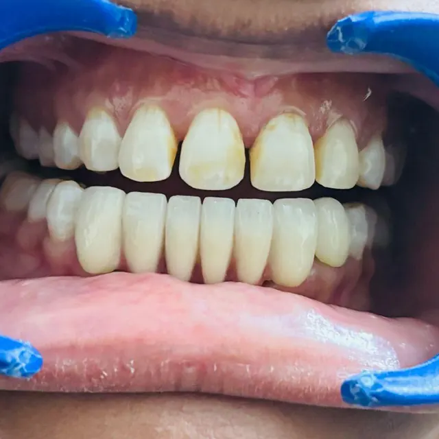 After view of a patient smile transformation